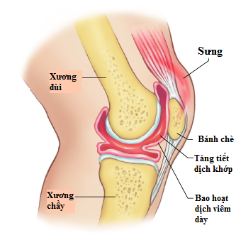 Có thể điều trị viêm khớp nhiễm khuẩn sinh mủ bằng kháng sinh không?
