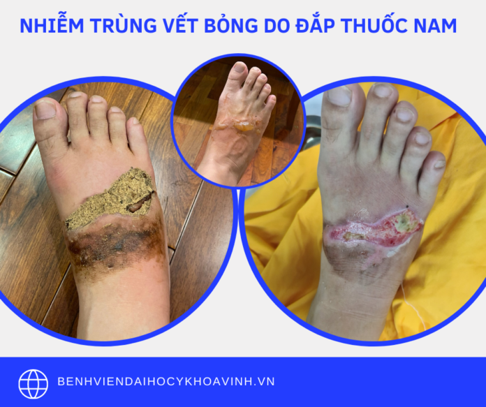 TÁC HẠI CỦA VIỆC CHỮA BỎNG KHÔNG ĐÚNG CÁCH