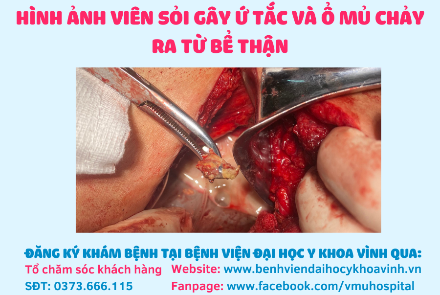 Mổ Thận Ứ Nước: Hướng Dẫn Chi Tiết và Lời Khuyên Hữu Ích