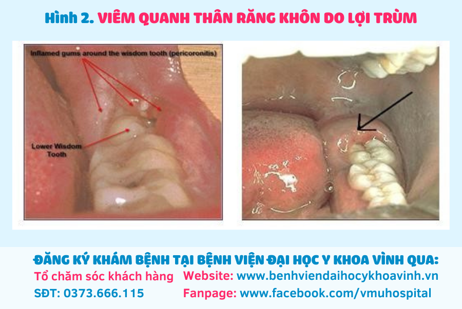 4. Lưu Ý Sau Khi Nhổ Răng Khôn