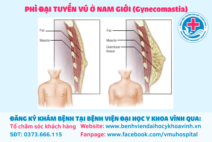 Phì đại tuyến vú nam có thể tái phát sau điều trị không?
