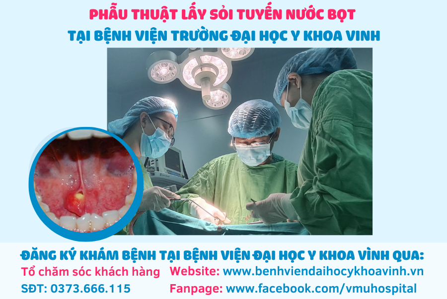 Viêm tuyến nước bọt dưới hàm do sỏi – Bệnh viện Đại học Y khoa ...