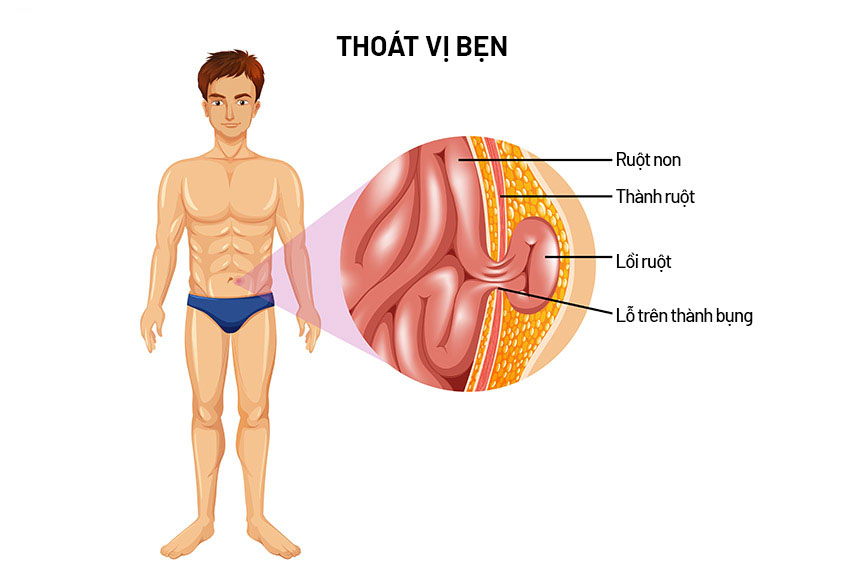 Các bước thực hiện phẫu thuật Lichtenstein.
