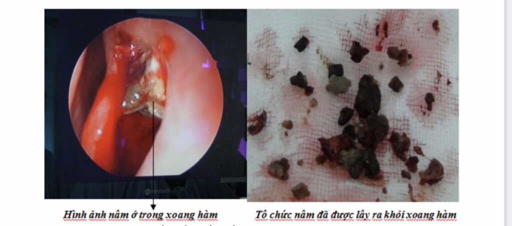 VIÊM XOANG DO NẤM – Bệnh viện Đại học Y khoa Vinh | Vinh Medical ...